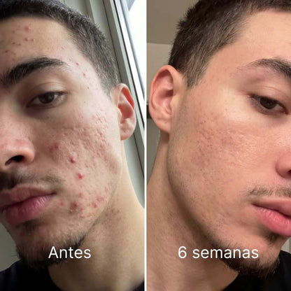Barra reparadora de cicatrices de acné EmiStick™