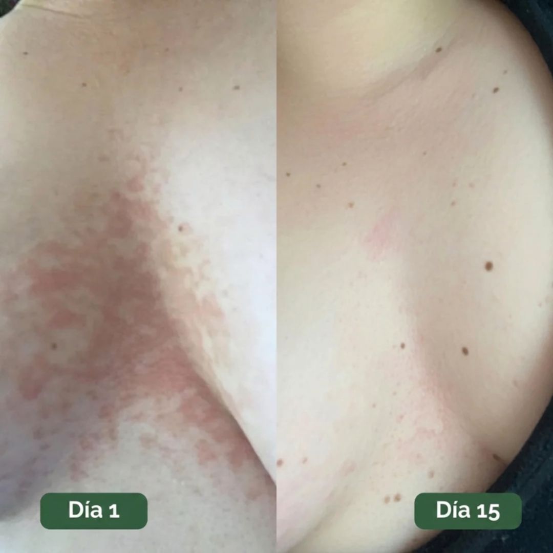 Umex™ | Tratamiento Antifúngico Botánico para la Piel