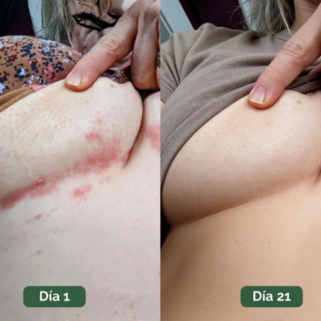 Umex™ | Tratamiento Antifúngico Botánico para la Piel
