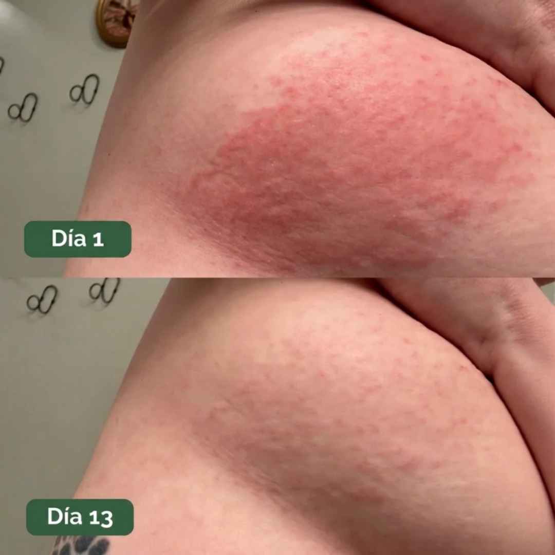 Umex™ | Tratamiento Antifúngico Botánico para la Piel